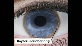 Wilsons disease  Kayser Fleischer ring [upl. by Martina]