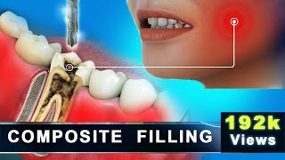 Composite Filling  Molar Cavity Filling with Composite  Advance 3D Dental Animation [upl. by Oderfliw]