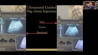 Augmented reality ultrasound guided PRP injection for the hip [upl. by Orozco]