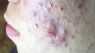 Amazing Blackhead Extraction [upl. by Euell85]