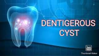 DENTIGEROUS CYST [upl. by Nyberg]