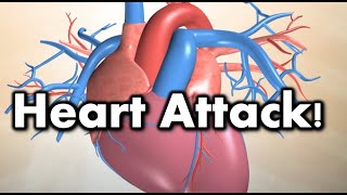 What causes a heart attack 1080p [upl. by Nwahser]