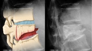 Vertebral Compression Fracture Explained by a Top Pain Physician in Las Vegas Nevada [upl. by Joelle]