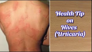 Hives  Urticaria  Causes Symptoms Treatment  Health Tips [upl. by Amsirhc]