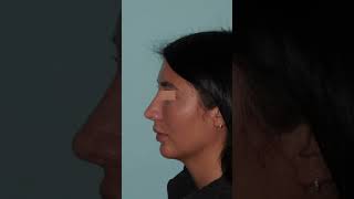 Rhinoplastie ultrasonique secondaire avec V inversé bec de corbin [upl. by Cora]