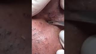 action blackheads poping acne epic video [upl. by Mundford]