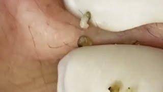 TOP OF BLACKHEADS REMOVAL FROM THE FACE AND LIPS 😨 relaxing blackheads [upl. by Nicola]