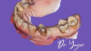 Tooth preparation for a zirconium crown Препарирование зуба под коронку из циркония [upl. by Frissell]