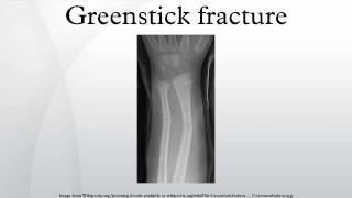 Greenstick fracture [upl. by Hareehahs]