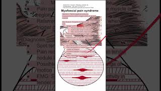 Myofascial pain syndrome [upl. by Vahe]