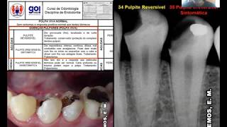 Urgências Endodônticas da Polpa Viva Prof Érico Lemos [upl. by Nickie]