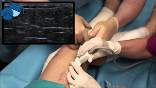 Foam sclerotherapy treatment of feeder veins varicose veins [upl. by Belier512]