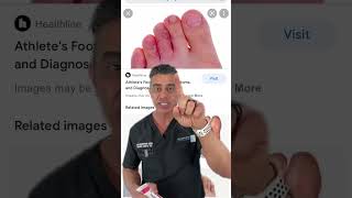 What Is Athletes Foot Foot Doctor Answer [upl. by Sibilla538]