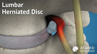 Lumbar Herniated Disc Overview [upl. by Miah]