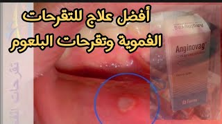 علاج التقرحات الفموية وتقرحات البلعوم anginovag spray دواء تقرحات الفم [upl. by Edgerton85]