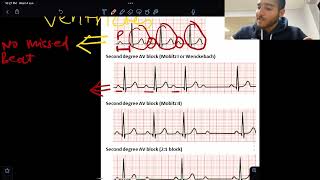 KROK 2 CARDIOLOGY RAPID REVISION [upl. by Alleciram]