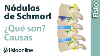 Nódulos de Schmorl  ¿Qué son y cómo sucede [upl. by Amrita]