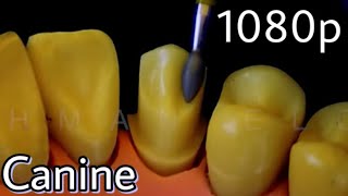 All Ceramic Crown Preparation for Maxillary Canine [upl. by Hattie]