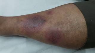 Erythema Nodosum in SLE [upl. by Spearing]