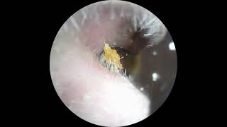 Unbelievable amount of wax removed from this ear  Surprise  the end earwaxremoval asmr [upl. by Anitra]