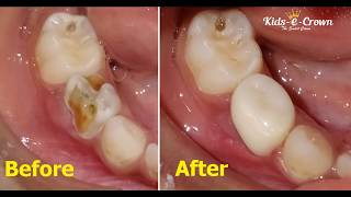 Zirconia Crowns Passive Fitment Procedure  KidseDental [upl. by Inilam]