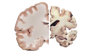 Alzheimers and the Brain [upl. by Caundra604]