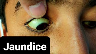 How Jaundice Looks Like [upl. by Anissej]