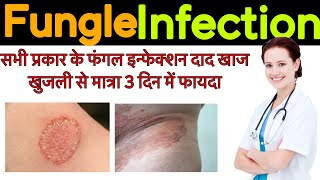 Fungle infection  Fungle infection treatment symptoms  precaution [upl. by Alysoun]