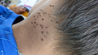 How to remove all hundred lice from short hair  Take out all of big lice from head [upl. by Seldan995]