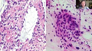 Tip31Pilocyticastrocytoma of an Adult [upl. by Abba485]