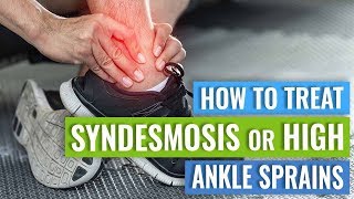 Syndesmosis or High Ankle Sprain Treatment [upl. by Ingvar]