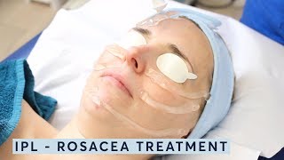 How to treat rosacea  IPL [upl. by Ponton]