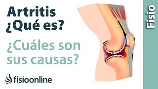 ¿Qué es una artritis y cuáles son sus causas [upl. by Hege]