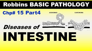 Chp15 Part4 Robbins Basic Patho  Diseases of INTESTINE  Dr Asif Lectures [upl. by Fennie]