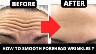 10 MIN  FOREHEAD LINES REMOVAL EXERCISE  GET RID OF WRINKLES ON FOREHEAD  GET RID OF WRINKLES [upl. by Abibah965]