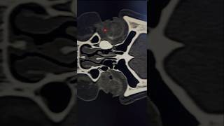 Dacryocystitis Due to Nasolacrimal Duct Blockage in EYECTDCG SCAN CTSCAN CTORBIT skullbase [upl. by Ynohtnaleahcim]