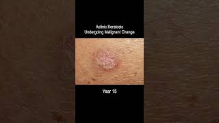 Skin Cancer Development Time Lapse Normal to Squamous Cell Carcinoma Over 25 Years [upl. by Eed]