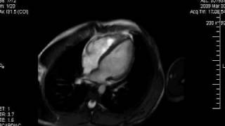 Cardiología HU  Resonancia Magnética Cardiaca Normal [upl. by Ilene]