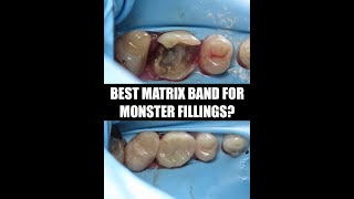 Best Matrix Band for Deep Cavities StepbyStep Guide to Perfect Contacts Every Time [upl. by Balling682]