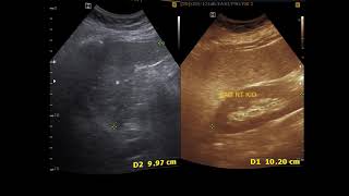 Ultrasound cases 361 of 2000  Utricle Cyst Splenic Cyst Hypoechoic nodule Breast Duct ectasia [upl. by Nygem]