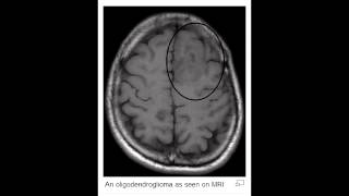 Oligodendroglioma [upl. by Africa51]