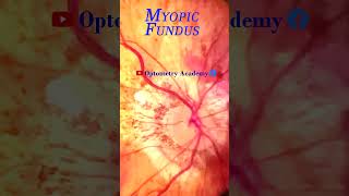 Myopic degeneration  Smartphone Fundus Videography  Fundus Photography  Short Video 63 [upl. by Airres815]