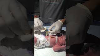 Cutting the navicular of a newborn baby sumitnicunursingstm youtubeshorts nursing newbornbaby [upl. by Aivon]