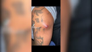 Popping huge blackheads and Pimple Popping  Best Pimple Popping Videos 158 [upl. by Lawtun259]