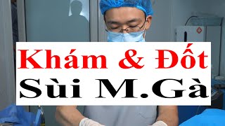 Cách Nhận Biết Sùi Mào Gà Điển Hình amp Đốt Sùi Mào Gà Bằng Dao Điện  Bác Sĩ Sắc [upl. by Shepard417]