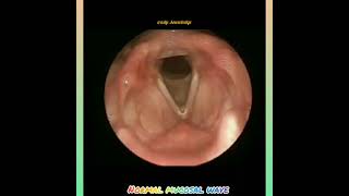 Stroboscopy  Normal mucosal wave of vocal fold [upl. by Lari]