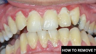 How To Remove PLAQUE From Teeth [upl. by Cesare]