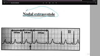 extrasystole [upl. by Marla]