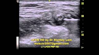 Ultrasound Guided Lateral Femoral Cutaneous Nerve LFCN Hydrodissection [upl. by Auqeenahs678]