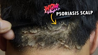 Wow Psoriasis Dry Scalp Scratching So Much Dandruff Removal Satisfying 363 [upl. by Anitirhc]